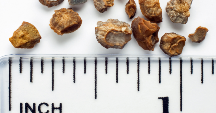 kidney stone