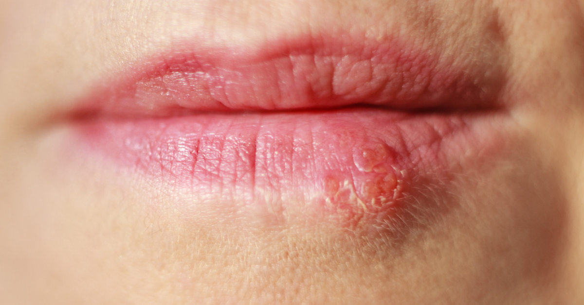 lip-sores-natural-health-techniques