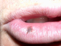 Melanotic macule of the lip