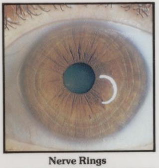 Nerve rings in an iris